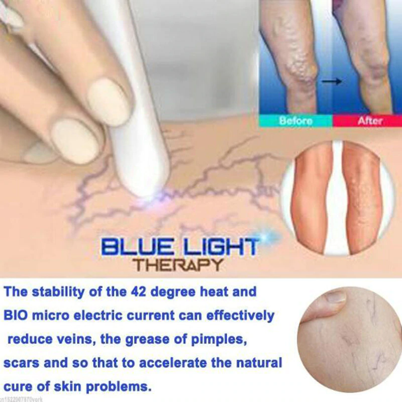 Heath-Blue-Light-Therapy-Varicose-Veins-Treatment-Laser-Pen-Soft-Scar-Wrinkle-Removal-Treatment-Acne-Laser (5)