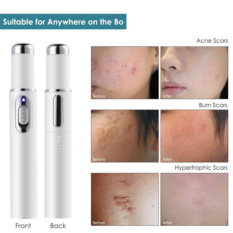 Heath-Blue-Light-Therapy-Varicose-Veins-Treatment-Laser-Pen-Soft-Scar-Wrinkle-Removal-Treatment-Acne-Laser (2)