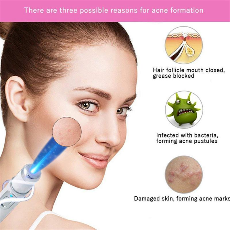 Hot-Heath-Blue-Light-Therapy-Varicose-Veins-Treatment-Laser-Pen-Soft-Scar-Wrinkle-Removal-Treatment-Acne (1)